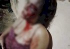 Grávida tem rosto deformado após ser espancada por marido em Tabatinga