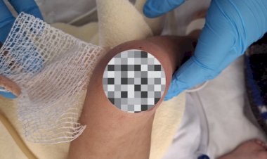 Criança especial sofre queimaduras nas pernas ao ser coberta com manta térmica na UTI infantil da Santa Casa de Jaú